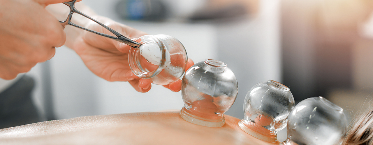 Cupping newcastle physiotherapy