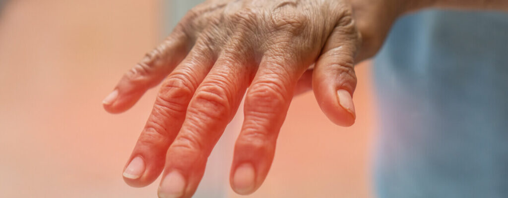 Arthritis-Can-Be-Exhausting